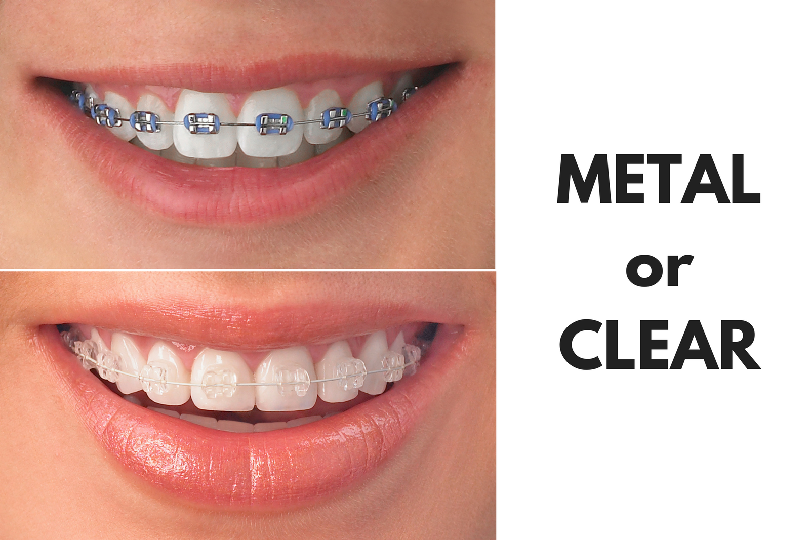 Braces treatment by Dr. Monika Sonawane, a highly respected dentist at All Dent, Dental Clinic in Ulwe, Navi Mumbai
