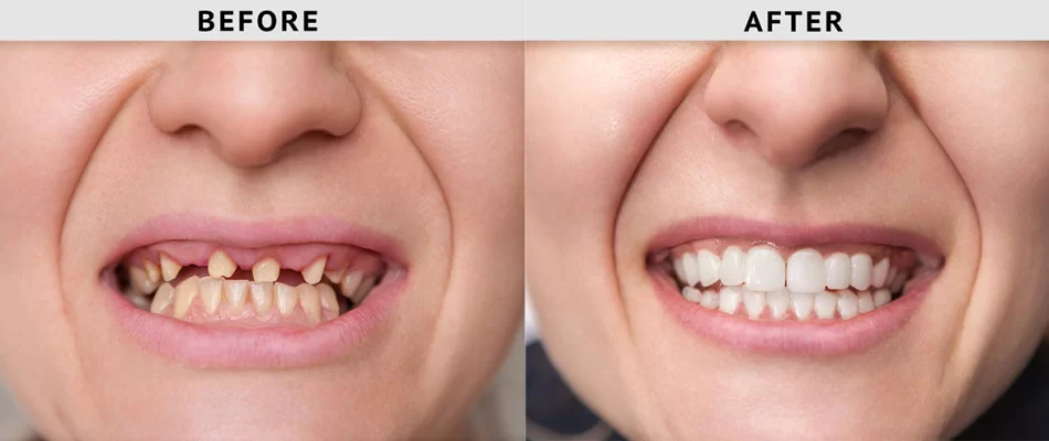 Dental Implant by Dr. Monika Sonawane, a highly respected dentist at All Dent, Dental Clinic in Ulwe, Navi Mumbai
