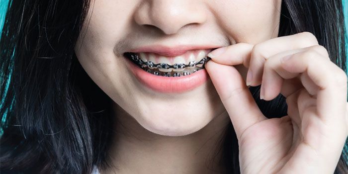 Braces treatment by Dr. Monika Sonawane, a highly respected dentist at All Dent, Dental Clinic in Ulwe, Navi Mumbai 