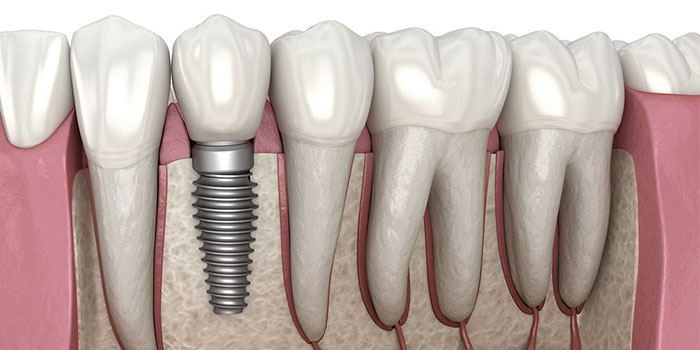 Dental Implant treatment by Dr. Monika Sonawane, a highly respected dentist at All Dent, Dental Clinic in Ulwe, Navi Mumbai 