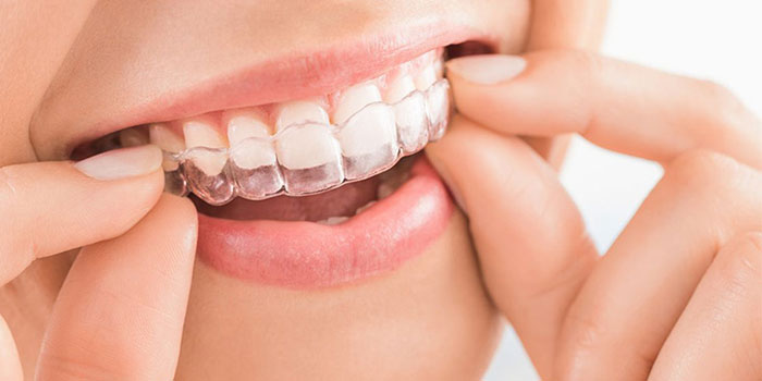 Invisalign tretament by Dr. Monika Sonawane, a highly respected dentist at All Dent, Dental Clinic in Ulwe, Navi Mumbai 