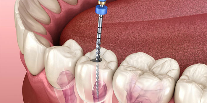 Root Canal Treatment by Dr. Monika Sonawane, a highly respected dentist at All Dent, Dental Clinic in Ulwe, Navi Mumbai.